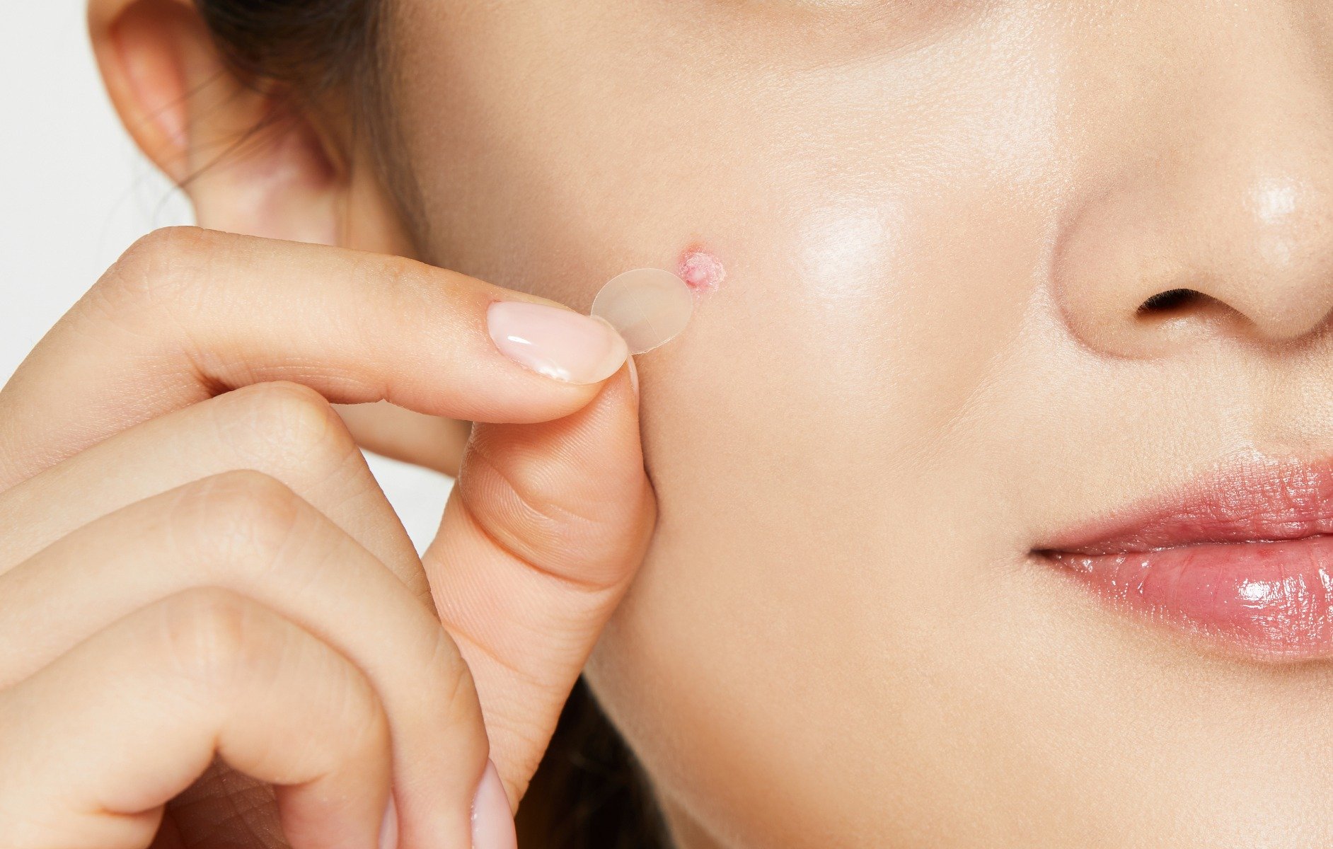 Nhiều phụ nữ mang thai bị nổi mụn suốt thai kỳ 