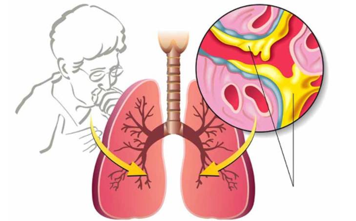 Nên sử dụng miếng dán chữa ho đờm hay sử dụng thuốc tây?