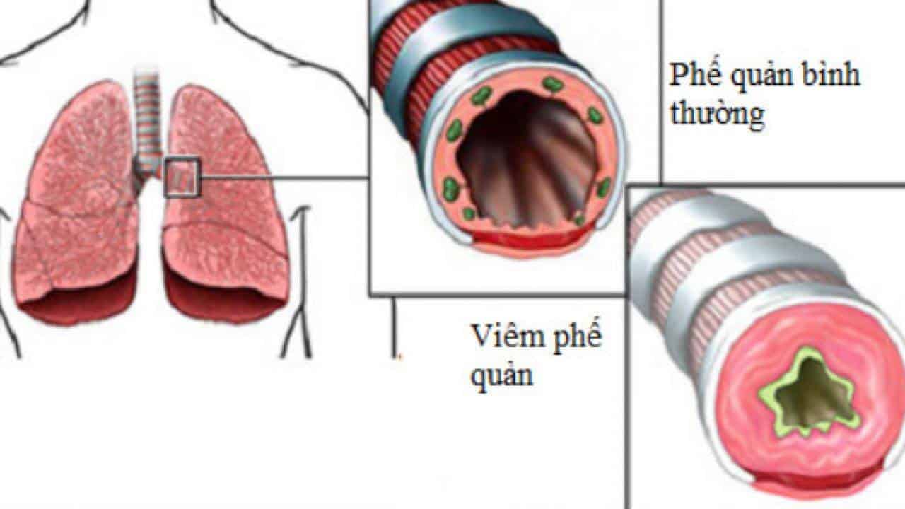 Viêm phế quản cấp là gì? Triệu chứng và cách điều trị